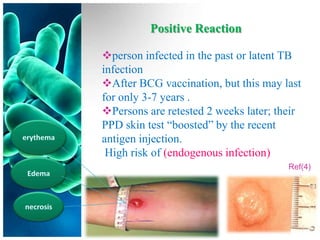 Positive Reaction

person infected in the past or latent TB
infection
After BCG vaccination, but this may last
for only 3-7 years .
Persons are retested 2 weeks later; their
PPD skin test “boosted” by the recent
antigen injection.
 High risk of (endogenous infection)
                                       Ref(4)
 