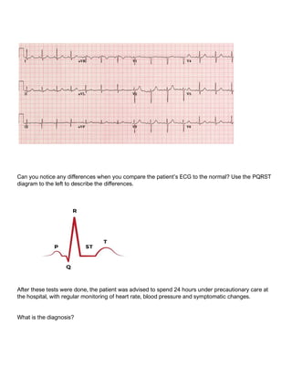 Can you notice any differences when you compare the patient’s ECG to the normal? Use the PQRST
diagram to the left to describe the differences.
After these tests were done, the patient was advised to spend 24 hours under precautionary care at
the hospital, with regular monitoring of heart rate, blood pressure and symptomatic changes.
What is the diagnosis?
 