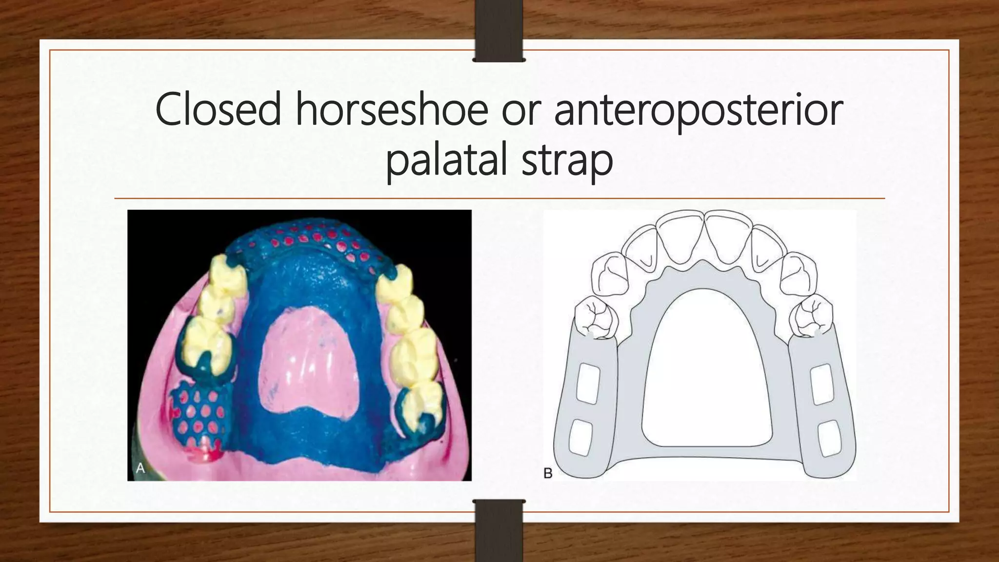 Palatable Strap Rpd Major and minor connectors | PPTX