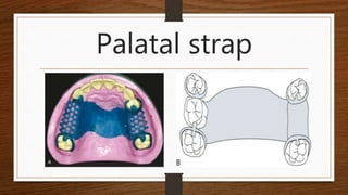 Palatable Strap Rpd Major and minor connectors | PPTX