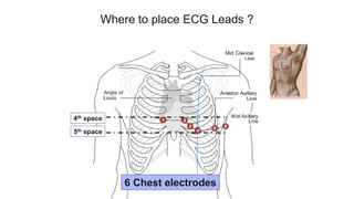 Where to place ECG Leads ?
6 Chest electrodes
4th space
5th space
 
