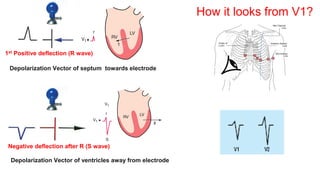 Depolarization Vector of ventricles away from electrode
Depolarization Vector of septum towards electrode
Negative deflection after R (S wave)
1st Positive deflection (R wave)
How it looks from V1?
 