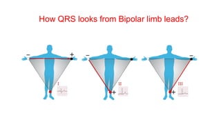 How QRS looks from Bipolar limb leads?
 
