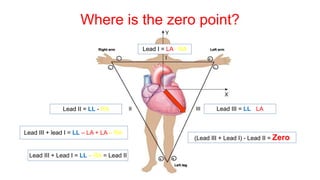 Lead I = LA - RA
Lead II = LL - RA Lead III = LL - LA
Where is the zero point?
(Lead III + Lead I) - Lead II = Zero
Lead III + lead I = LL – LA + LA – RA
Lead III + Lead I = LL – RA = Lead II
 