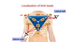 Localization of limb leads
aVR
Inferior wall
Lateral wall
 