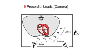 6 Precordial Leads (Camera)
 