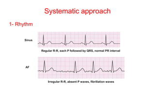 Systematic approach
1- Rhythm
Sinus
AF
Regular R-R, each P followed by QRS, normal PR interval
Irregular R-R, absent P waves, fibrillation waves
 