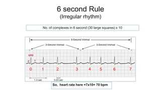 6 second Rule
(Irregular rhythm)
No. of complexes in 6 second (30 large squares) x 10
0 1 2 3 4 5 6 7
So, heart rate here =7x10= 70 bpm
 