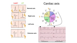 Lead I aVF
Normal axis
Right axis
Left axis
Extreme axis
Cardiac axis
 