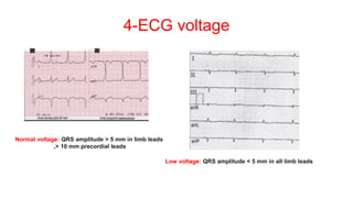 4-ECG voltage
Normal voltage: QRS amplitude > 5 mm in limb leads
,> 10 mm precordial leads
Low voltage: QRS amplitude < 5 mm in all limb leads
 