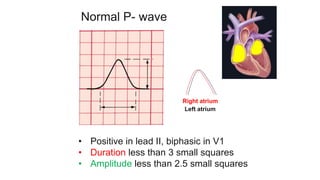 Normal P- wave
• Positive in lead II, biphasic in V1
• Duration less than 3 small squares
• Amplitude less than 2.5 small squares
Right atrium
Left atrium
 