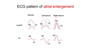 ECG pattern of atrial enlargement
Left atrium Right atrium
Normal
V1
Lead II
Lead II
 