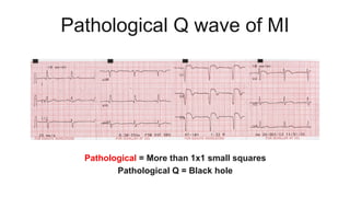Pathological Q wave of MI
Pathological = More than 1x1 small squares
Pathological Q = Black hole
 