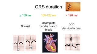 QRS duration
< 100 ms 100-120 ms > 120 ms
Normal
Incomplete
bundle branch
block
BBB
Ventricular beat
 