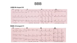 BBB
LBBB:M shaped V6
RBBB: M shaped V1
 