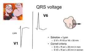 QRS voltage
 