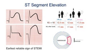 ST Segment Elevation
Earliest reliable sign of STEMI
 