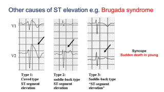Other causes of ST elevation e.g. Brugada syndrome
Syncope
Sudden death in young
 