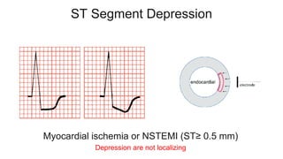 ST Segment Depression
Myocardial ischemia or NSTEMI (ST≥ 0.5 mm)
Depression are not localizing
 
