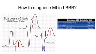 How to diagnose MI in LBBB?
 