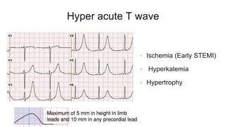 Hyper acute T wave
• Ischemia (Early STEMI)
• Hyperkalemia
• Hypertrophy
 