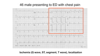 46 male presenting to ED with chest pain
Ischemia (Q wave, ST, segment, T wave), localization
 