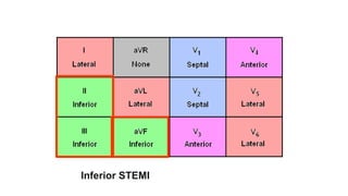 Inferior STEMI
 