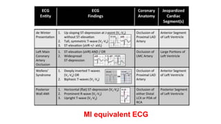 MI equivalent ECG
 