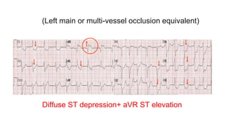 (Left main or multi-vessel occlusion equivalent)
Diffuse ST depression+ aVR ST elevation
 