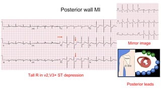 Posterior wall MI
Tall R in v2,V3+ ST depression
Mirror image
Posterior leads
 