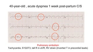 40-year-old , acute dyspnea 1 week post-partum C/S
Pulmonary embolism
Tachycardia, S1Q3T3, tall R in aVR, RV strain (Inverted T in precordial leads)
 