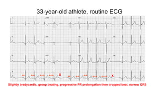 33-year-old athlete, routine ECG
Slightly bradycardic, group beating, progressive PR prolongation then dropped beat, narrow QRS
x x
 