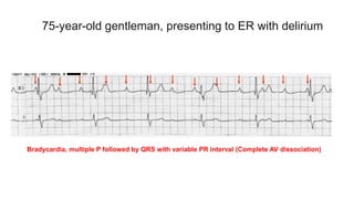 75-year-old gentleman, presenting to ER with delirium
Bradycardia, multiple P followed by QRS with variable PR interval (Complete AV dissociation)
 