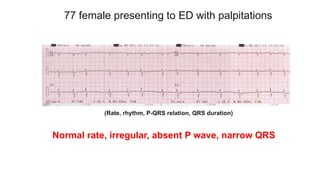 77 female presenting to ED with palpitations
(Rate, rhythm, P-QRS relation, QRS duration)
Normal rate, irregular, absent P wave, narrow QRS
 