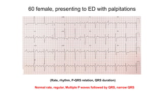 60 female, presenting to ED with palpitations
(Rate, rhythm, P-QRS relation, QRS duration)
Normal rate, regular, Multiple P waves followed by QRS, narrow QRS
 