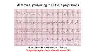 20 female, presenting to ED with palpitations
(Rate, rhythm, P-QRS relation, QRS duration)
Tachycardia, regular, P wave after QRS, narrow QRS
 