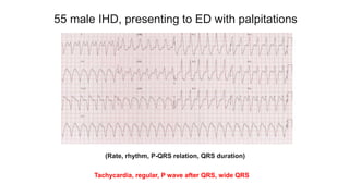55 male IHD, presenting to ED with palpitations
(Rate, rhythm, P-QRS relation, QRS duration)
Tachycardia, regular, P wave after QRS, wide QRS
 