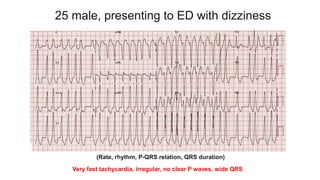 25 male, presenting to ED with dizziness
Very fast tachycardia, irregular, no clear P waves, wide QRS
(Rate, rhythm, P-QRS relation, QRS duration)
 