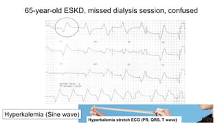 Hyperkalemia (Sine wave)
65-year-old ESKD, missed dialysis session, confused
Hyperkalemia stretch ECG (PR, QRS, T wave)
 