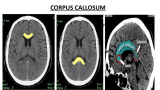 Splenum Radiological anatomy of brain | PPTX