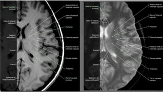 Uncus Radiopaedia Radiological anatomy of brain | PPTX
