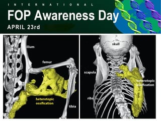 Fibrodysplasia ossificans progressiva | PDF