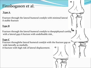 Finnbogason et al.
Type A

Fracture through the lateral humeral condyle with minimal lateral gap .
A stable fracture

Type B

Fracture through the lateral humeral condyle to theepiphyseal cartilage
with a lateral gap.A fracture with undefinable risk.

Type C
Fracture throughthe lateral humeral condyle with the fracture gap as
wide laterally as medially.
A fracture with high risk of lateral displacement.
 