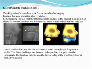 Lateral Condyle fractures x rays .

The diagnosis of a lateral condyle fracture can be challenging.
Fracture lines are sometimes barely visible .
Remembering the fact that the lateral condyle fracture is the second most common
elbow-fracture in children and because you know where to look for will help you




lateral condyle fracture. On the x-ray only a small metaphyseal fragment is
visible. The detatched fragment however is larger than it appears on the
radiograph. The fracture extents into the lateral ridge of the trochlea. Elbow is
probably unstable.
 