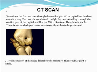 CT SCAN
 Sometimes the fracture runs through the ossified part of the capitellum. In those
 cases it is easy.The case shows a lateral condyle fracture extending through the
 ossified part of the capitellum.This is a Milch I fracture. The elbow is stable.
 There is too much displacement so osteosynthesis has to be performed.




CT reconstruction of displaced lateral condyle fracture. Humeroulnar joint is
stable.
 