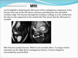 MRI
can be helpfull in depicting the full extent of the cartilaginous component of the
fracture.The case on the left shows a fracture extending into the unossified
trochlear ridge. The fracture through the trochlear cartilage is so far medial that
the ulna is only supported on the medial side.This means that the elbowjoint is
unstable




MR of lateral condyle fracture. Milch II and unstable elbow. T2 image with fat
saturation on the right shows cartilaginous fracture. Fracture-fragment
surrounded by synovial fluid
 