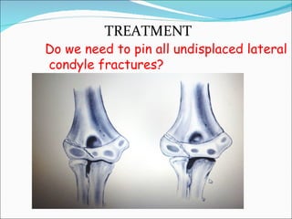 TREATMENT
Do we need to pin all undisplaced lateral
condyle fractures?
 