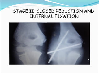 STAGE II CLOSED REDUCTION AND
      INTERNAL FIXATION
 