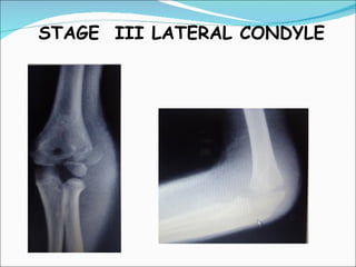 STAGE III LATERAL CONDYLE
 