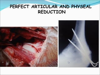PERFECT ARTICULAR AND PHYSEAL
          REDUCTION
 